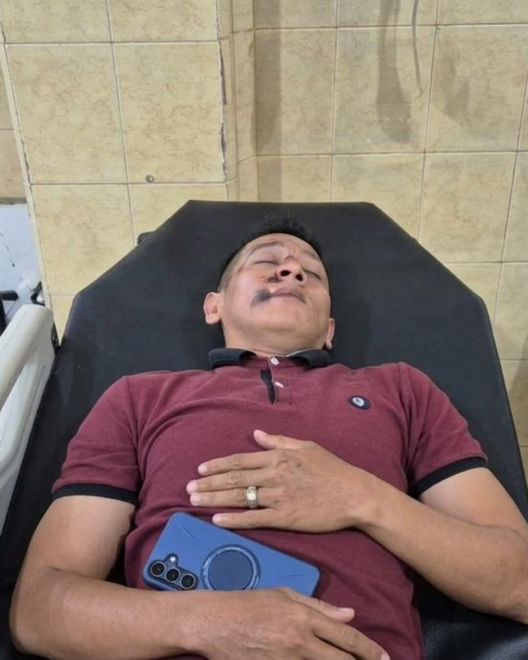Perawat RS Graha Sehat Kraksaan Diduga Dianiaya Satpam, Korban Alami Luka Serius Dibagian Wajah
